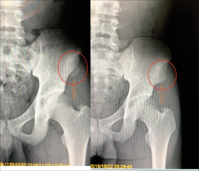 剛受傷的骨折形式（左），骨折已癒合（右）。（照片提供／李佳霖）